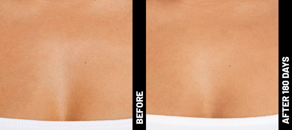 erin, decolletage results after 180 days