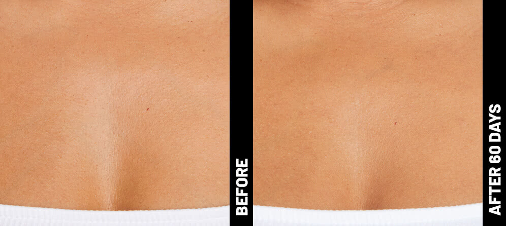 erin, decolletage results after 60 days