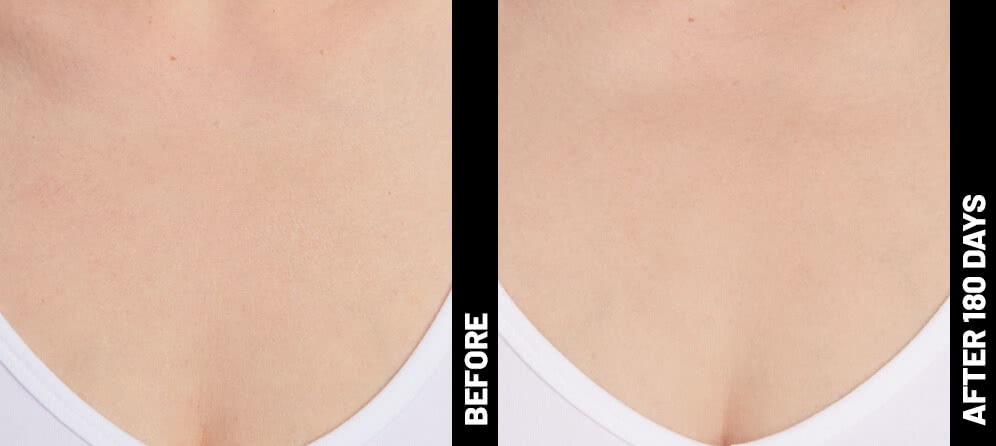 grace, decolletage results after 180 days