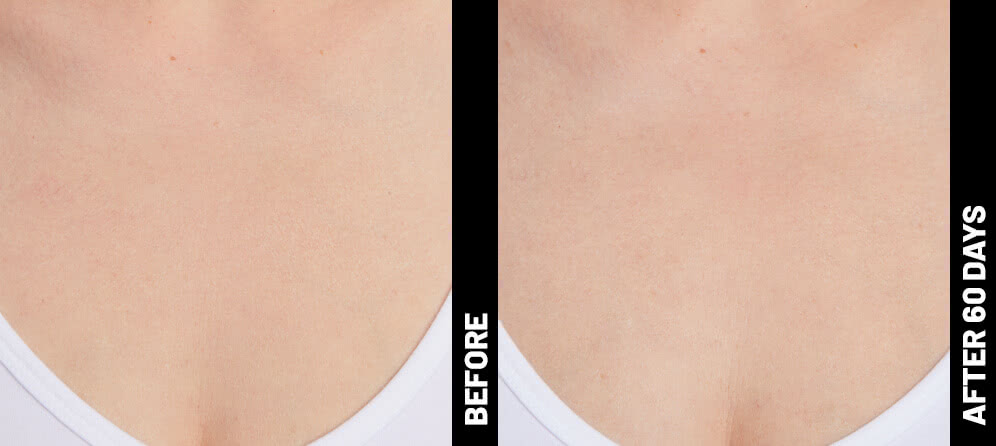 grace, decolletage results after 60 days