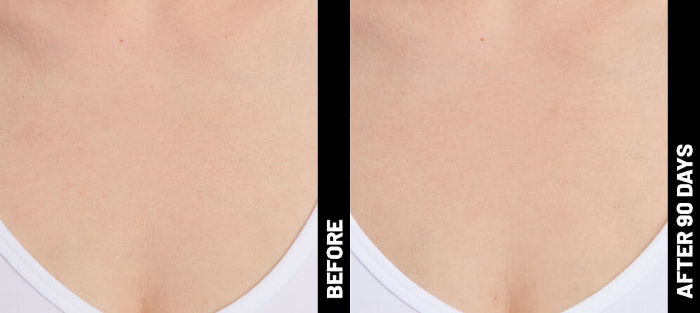 grace, decolletage results after 90 days