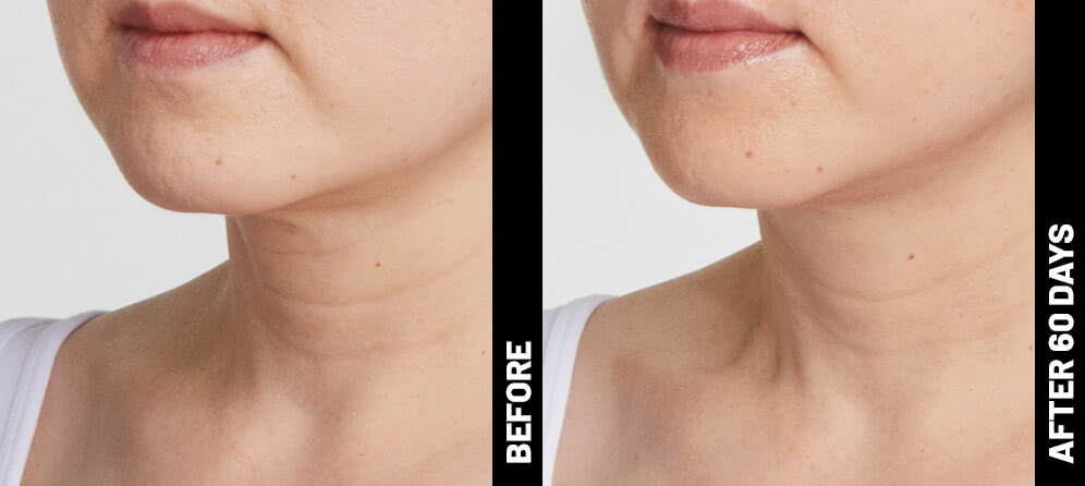 grace, neck results after 60 days